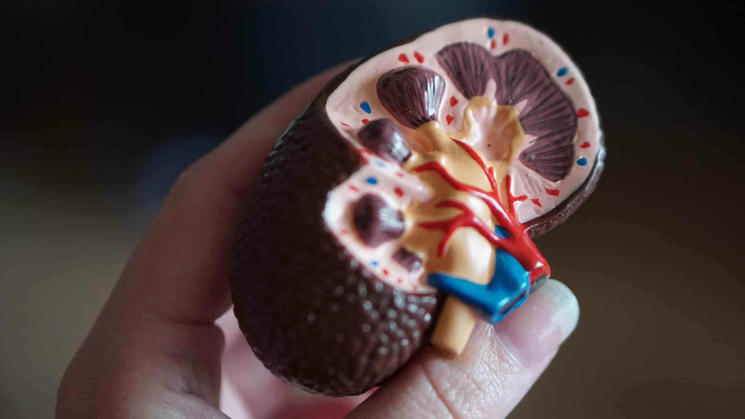 Everything you need to know about Crohn’s and Kidney Stones