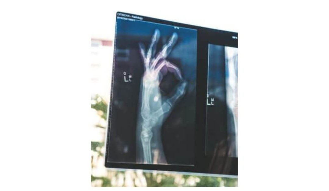 Bone Health with IBD